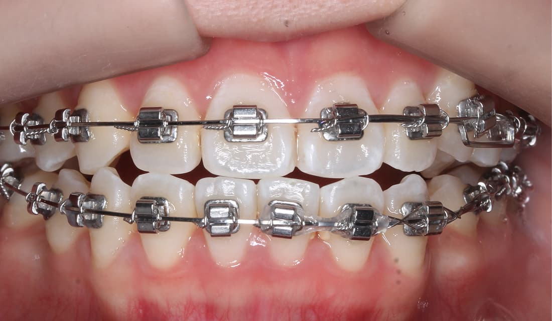 교정 치료 치료중