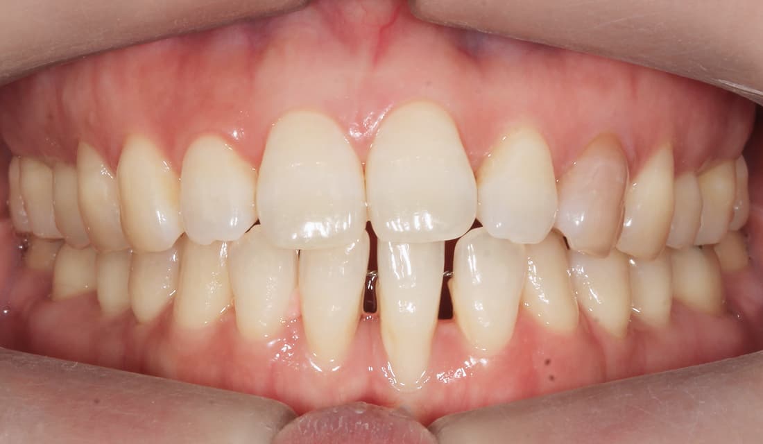 교정 치료 치료 전