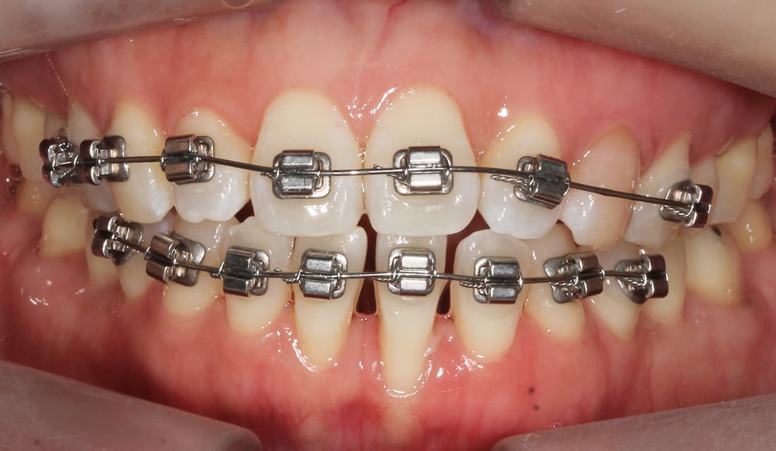 교정 치료 치료중