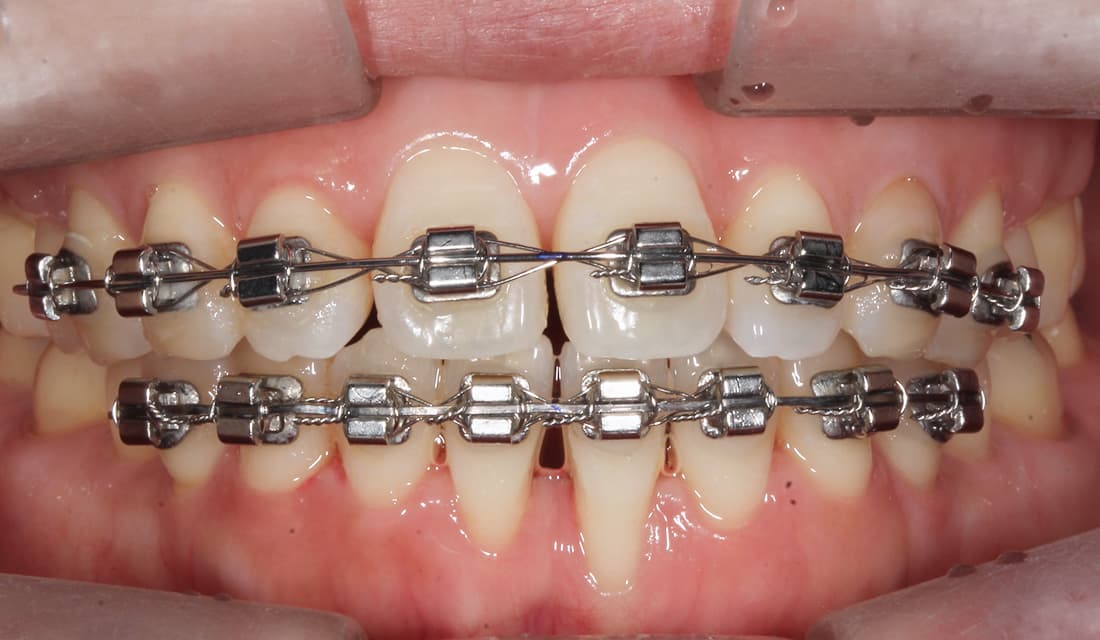 교정 치료 치료중