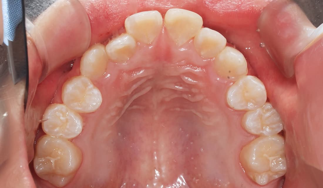 교정 치료 치료 전