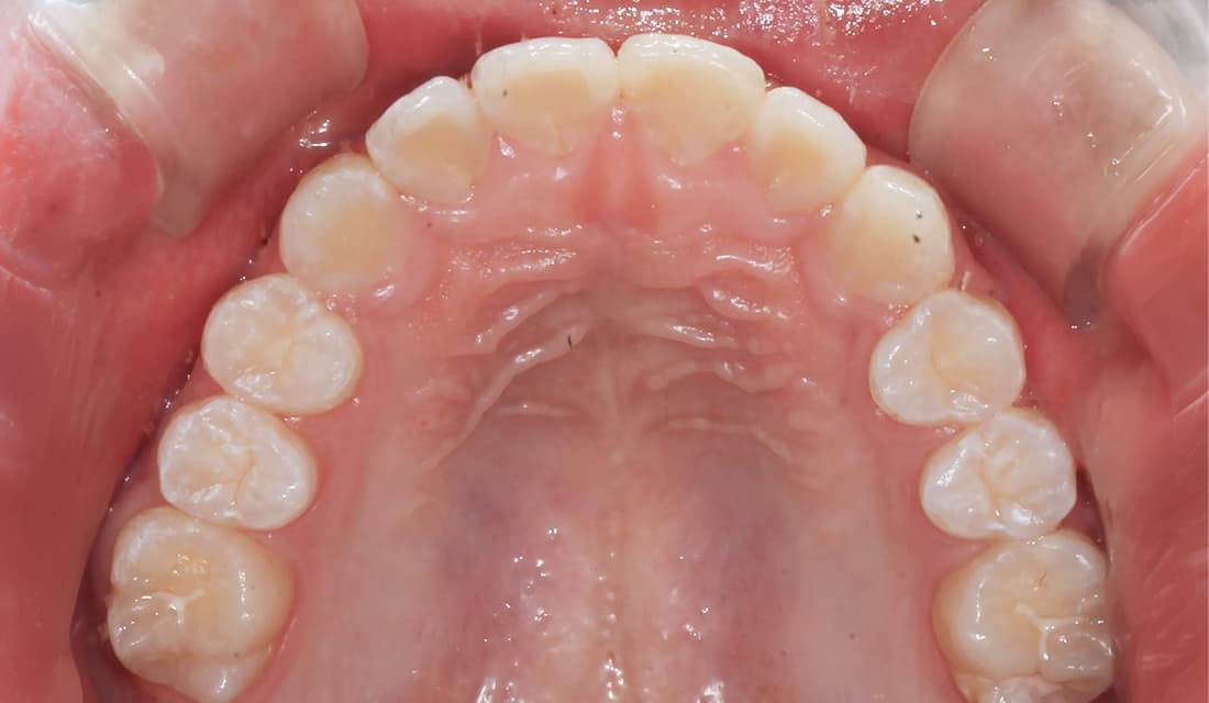 교정 치료 치료 후