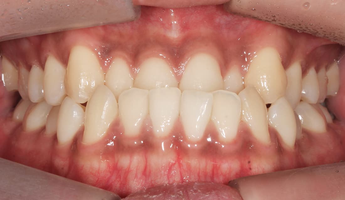 교정 치료 치료 전