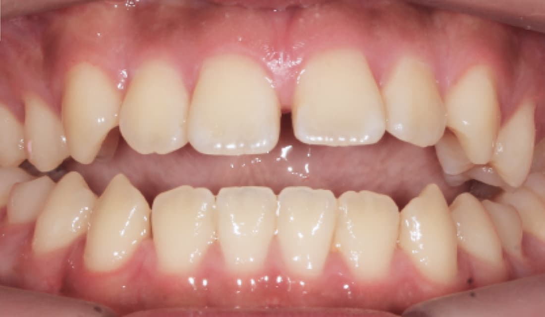 교정 치료 치료 전