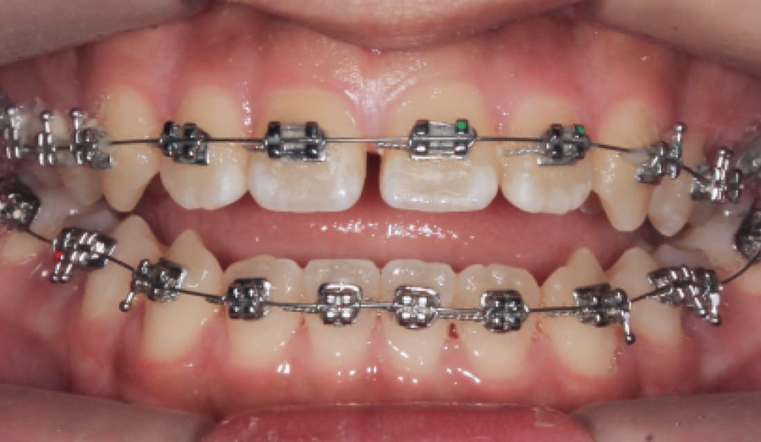 교정 치료 치료중