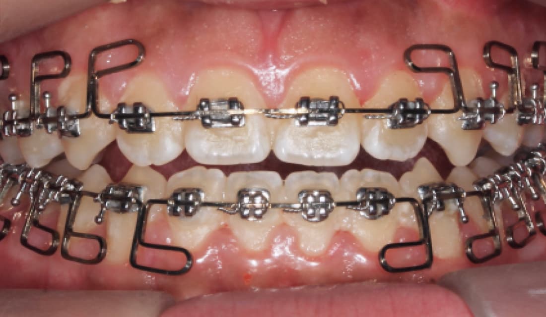 교정 치료 치료중