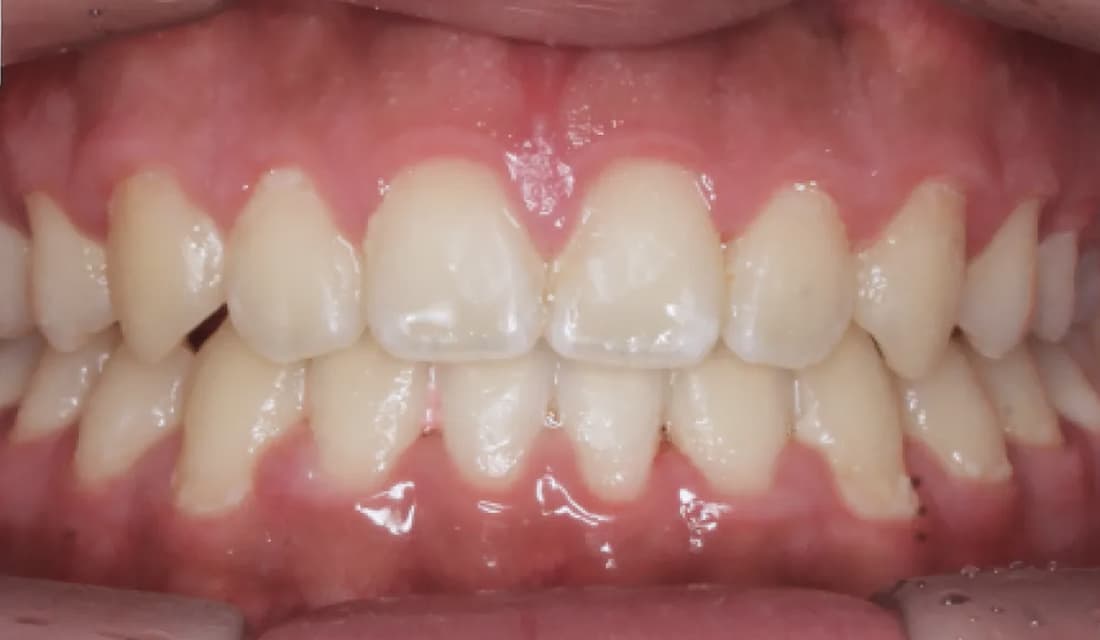 교정 치료 치료 완료